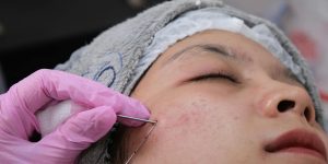 Microneedling