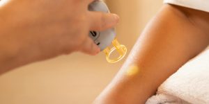 Laserontharing Huizen